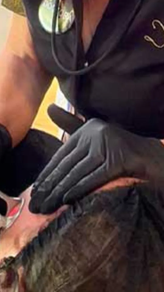 Story de Instagram de una clínica estética con un tratamiento láser en Benalmádena