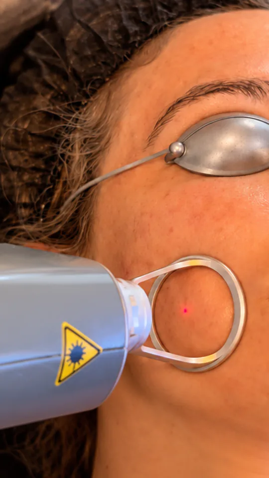 Story de Instagram de una clínica estética durante una sesión de láser facial en Benalmádena